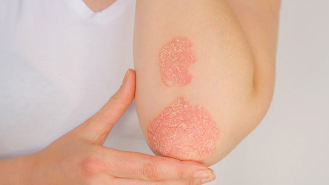Elbow with psoriasis.