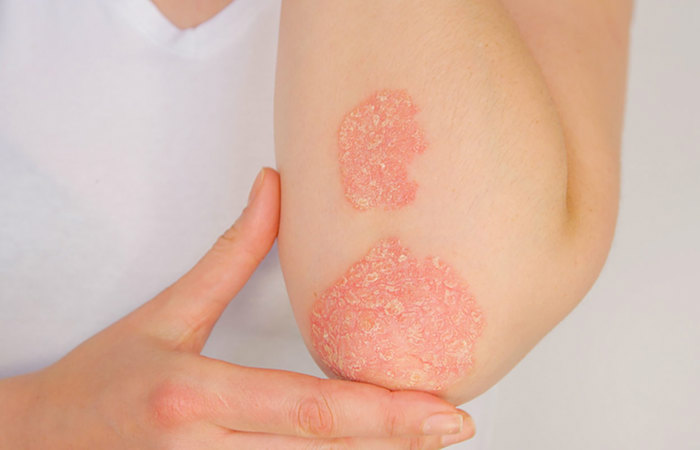 Elbow with psoriasis.