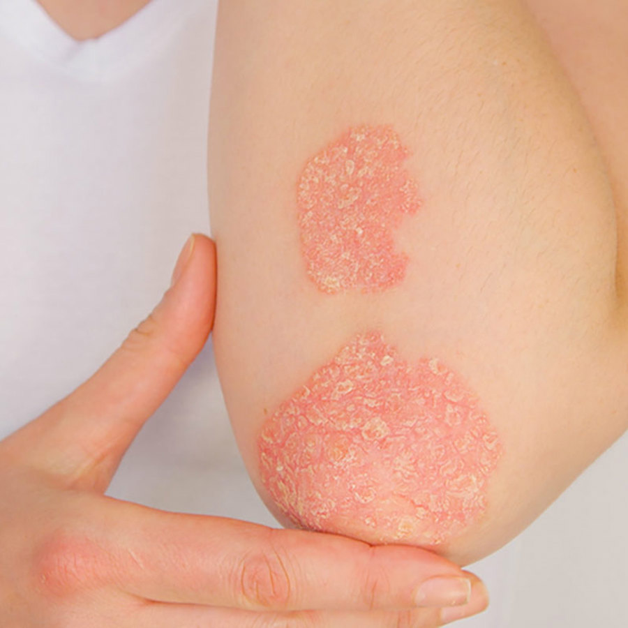 Elbow with psoriasis.