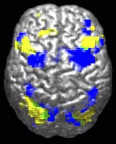 MRI image comparison between people with ASD and people without