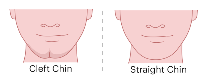 Diagram of a cleft vs straight chin.
