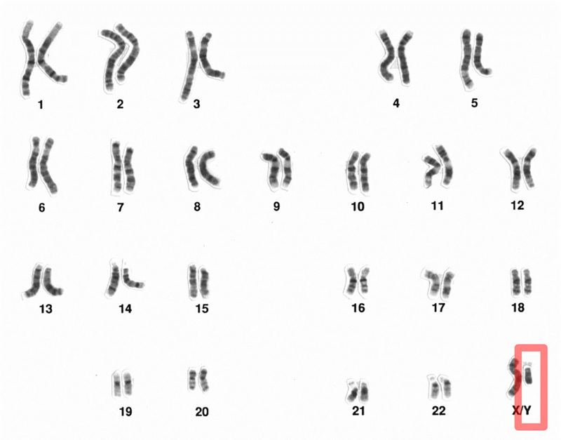 XY karyotype.