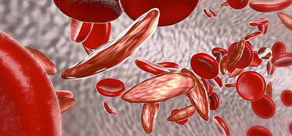 Sickle shaped blood cells.