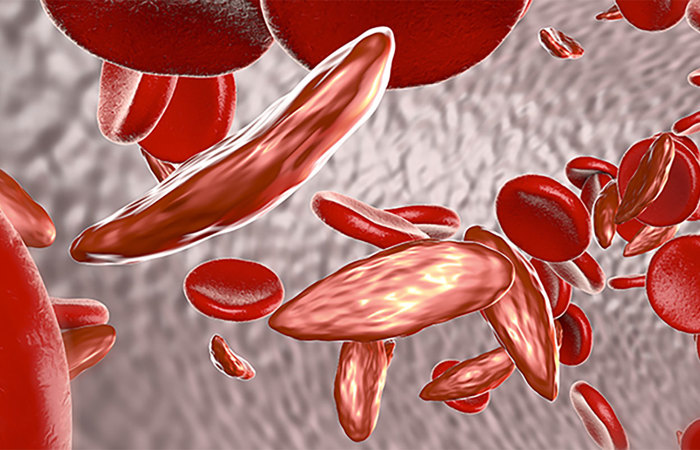 Sickle cell anemia 3D illustration.