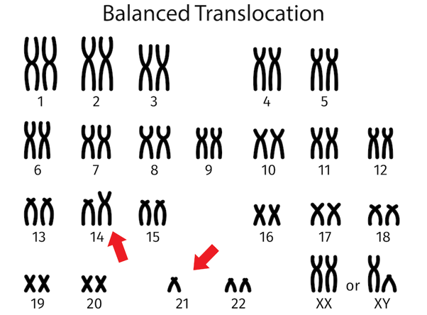 Balanced translocation.