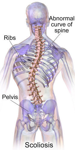 Scoliosis.