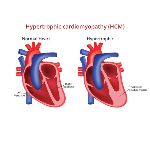 Normal vs. hypertrophic hearts.