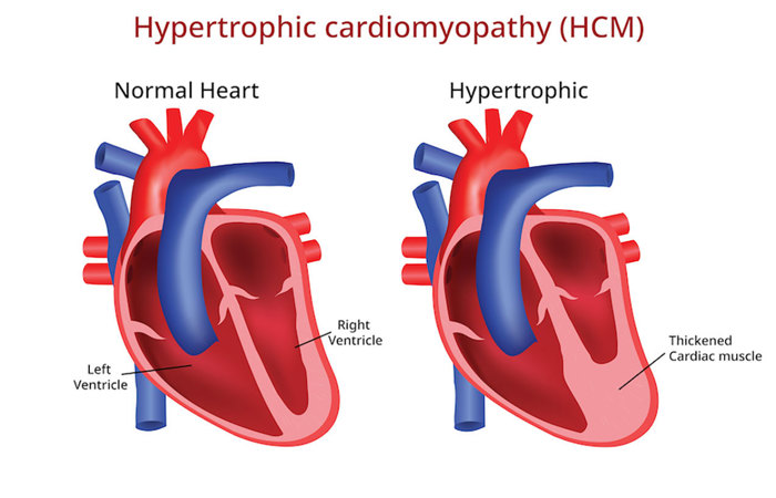 Normal vs. hypertrophic hearts.