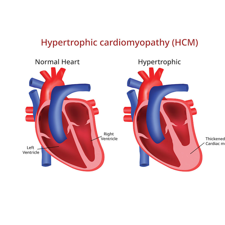 Normal vs. hypertrophic hearts.