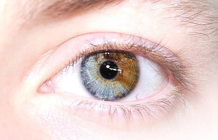 Sectoral heterochromia.