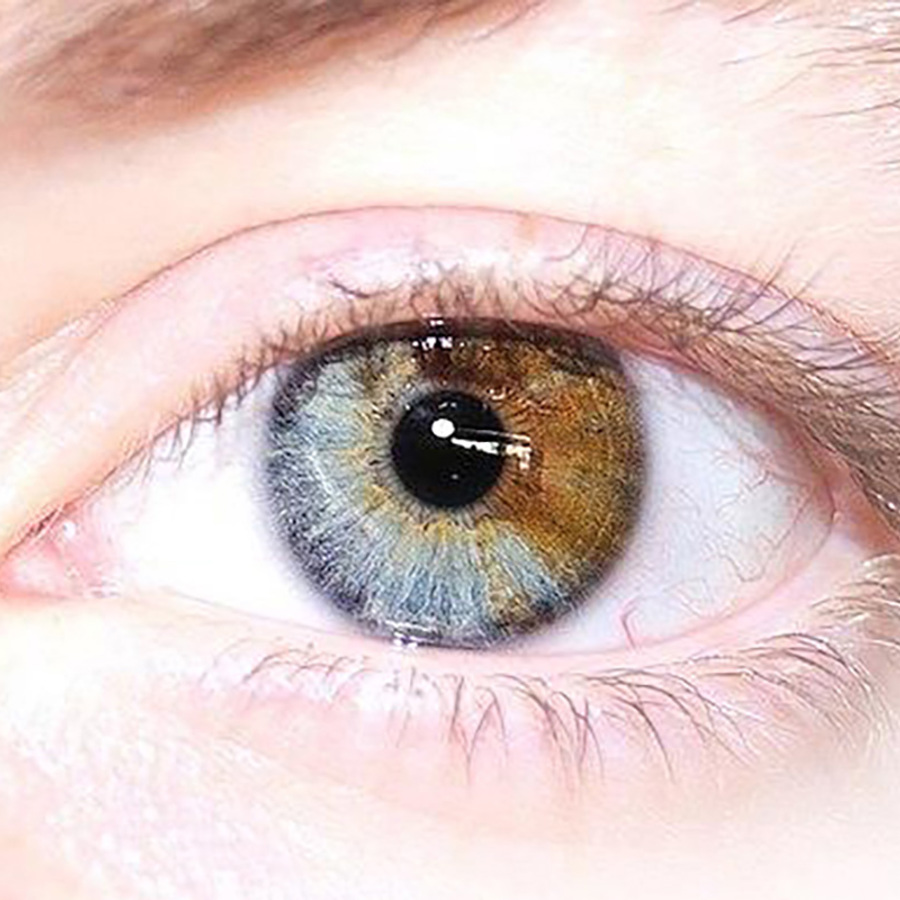 Sectoral heterochromia.