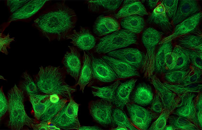 Green fluorescent protein (GFP) cancer cells.