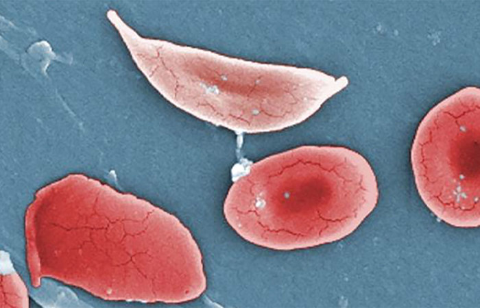 Sickle shaped blood cells.