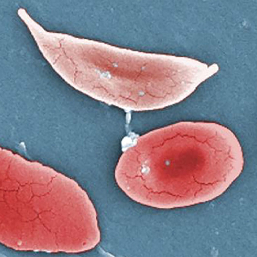 Sickle shaped blood cells.
