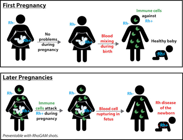 Rh disease of the newborn.