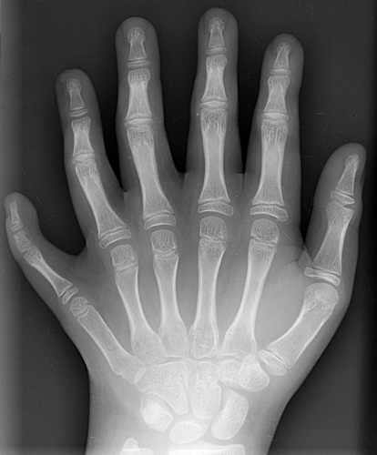 Polydactyly, a person born with extra fingers.