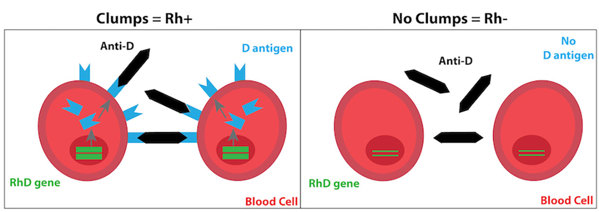 Diagram of how a red blood cell with D antigen will bind to anti-D, while a blood cell without this antigen will not.