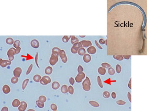 Sickle-shaped blood cells