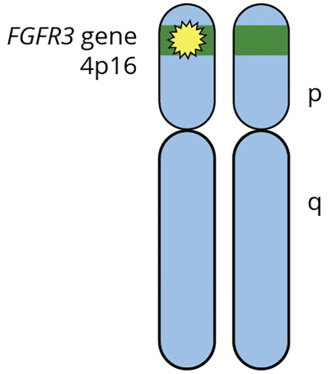 dwarfism karyotype