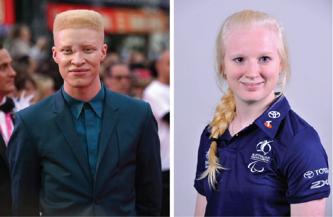 Two people with albinism