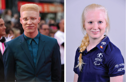 Two people with albinism
